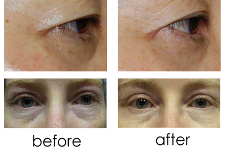 Photo source: Lumiere Dermatology